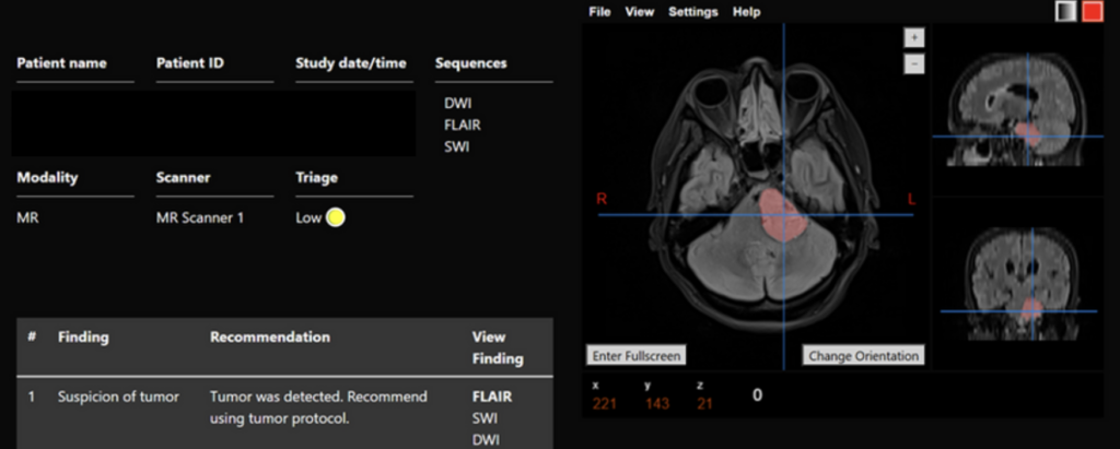 Clinical example of Apollo™ - Outpatient with flagged tumor compressing the brainstem